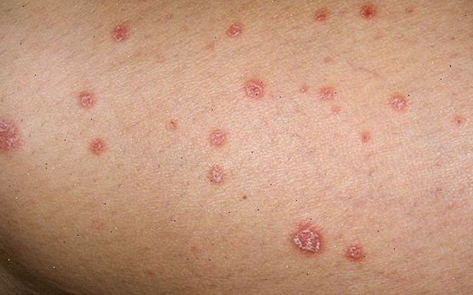 Bệnh Lậu là một căn bệnh nguy hiểm