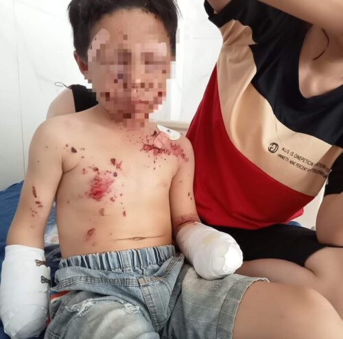 Bé trai bị cut 2 tay và nhiều vết thương khác trên người